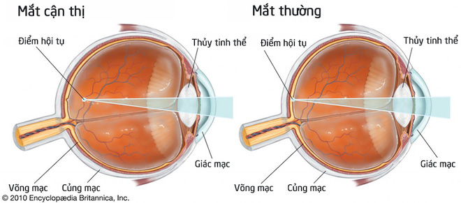 So sánh kết quả chứng bệnh cận thị và mắt thường