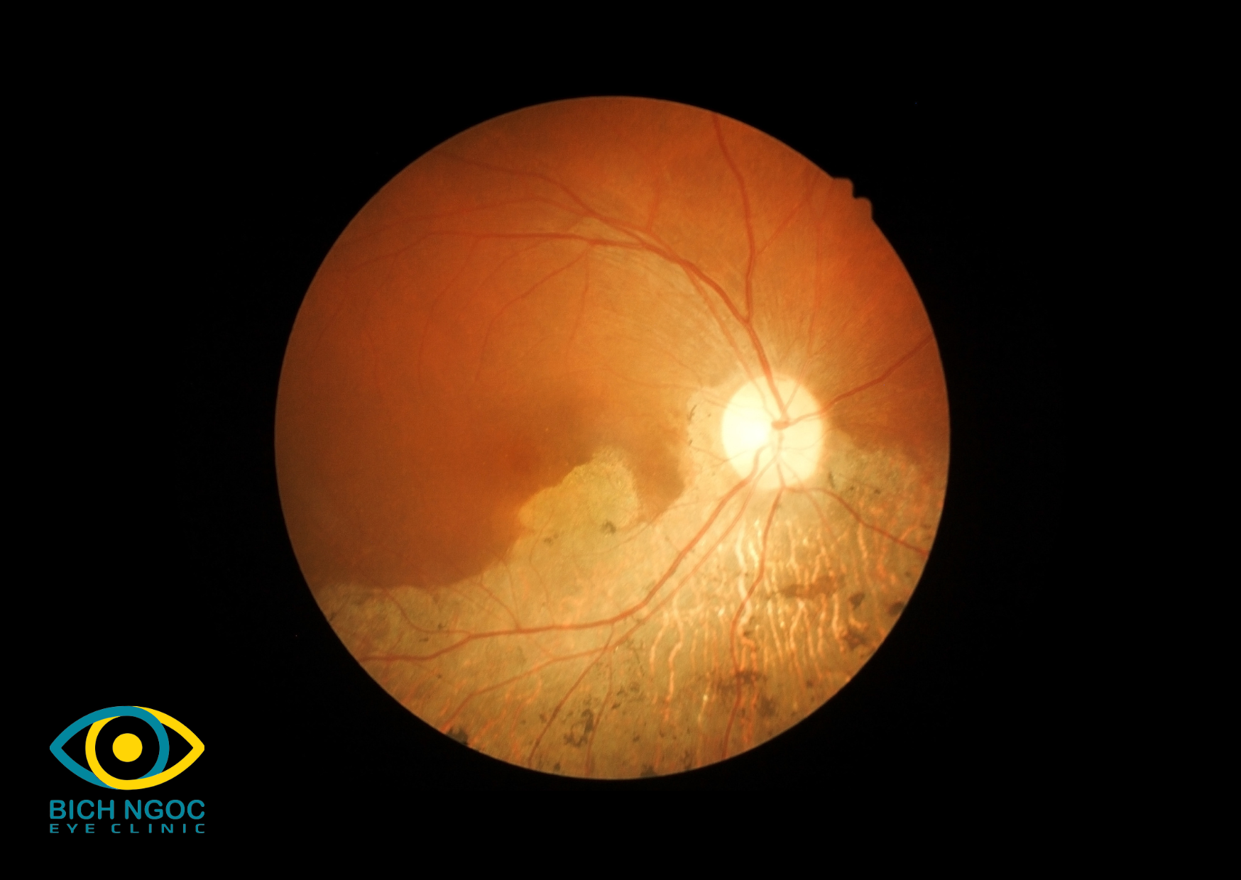 tổn thương võng mạc, giác mạc