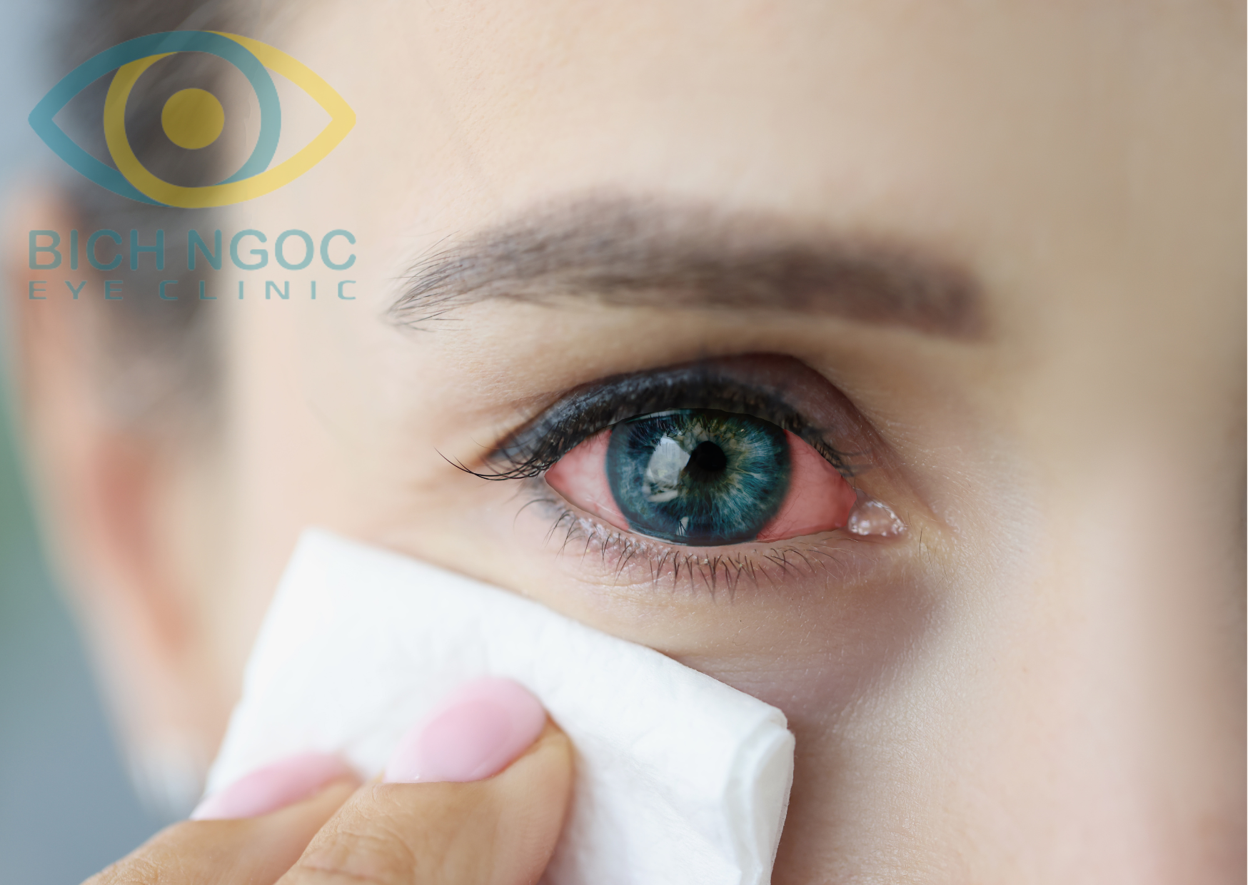 Vệ sinh mắt cải thiện đau mắt đỏ