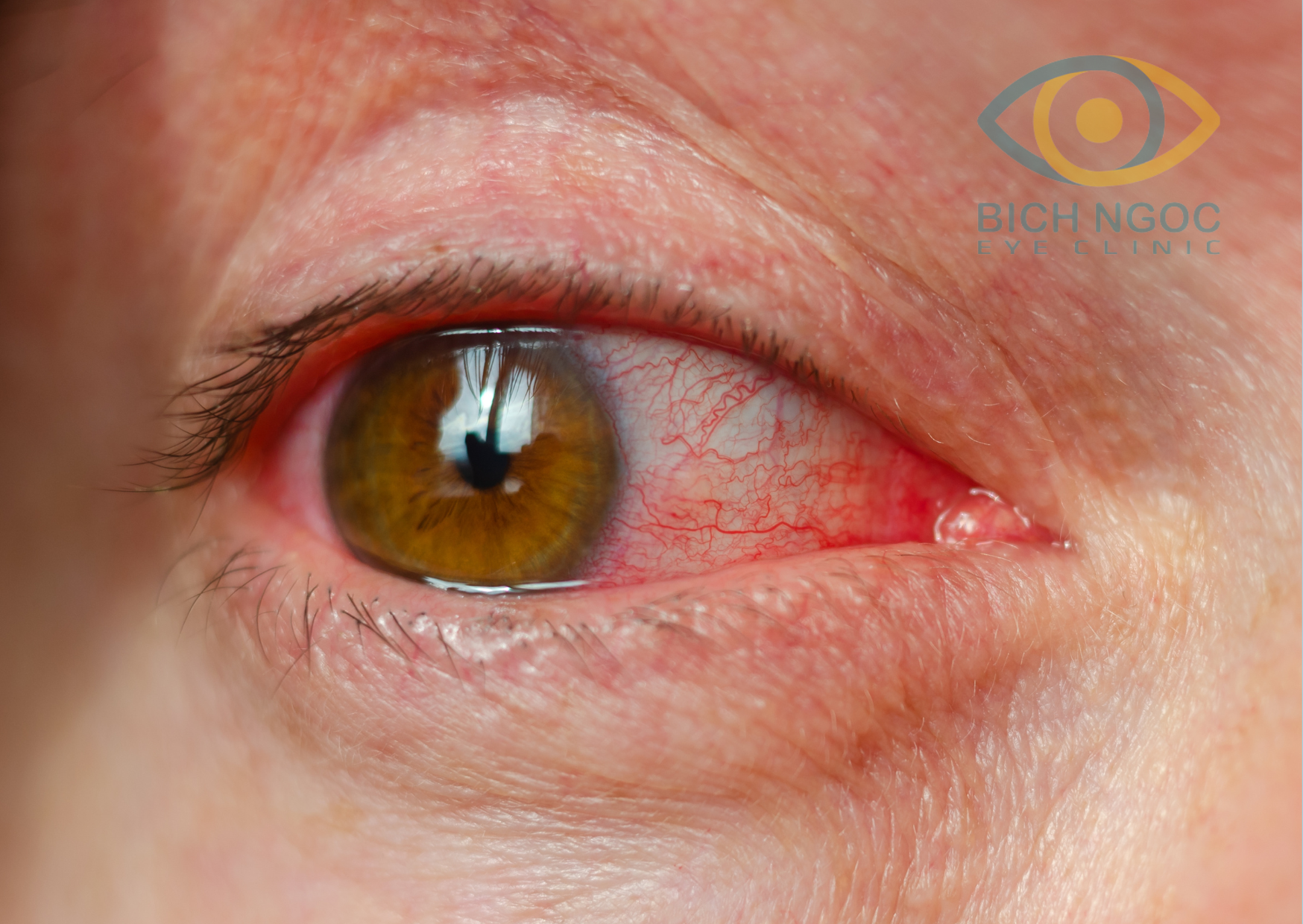 ngứa khóe mắt do dị ứng